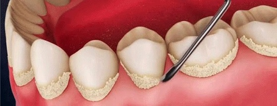 Чистка зубов от камня: кому подходит и как проводится эта процедура