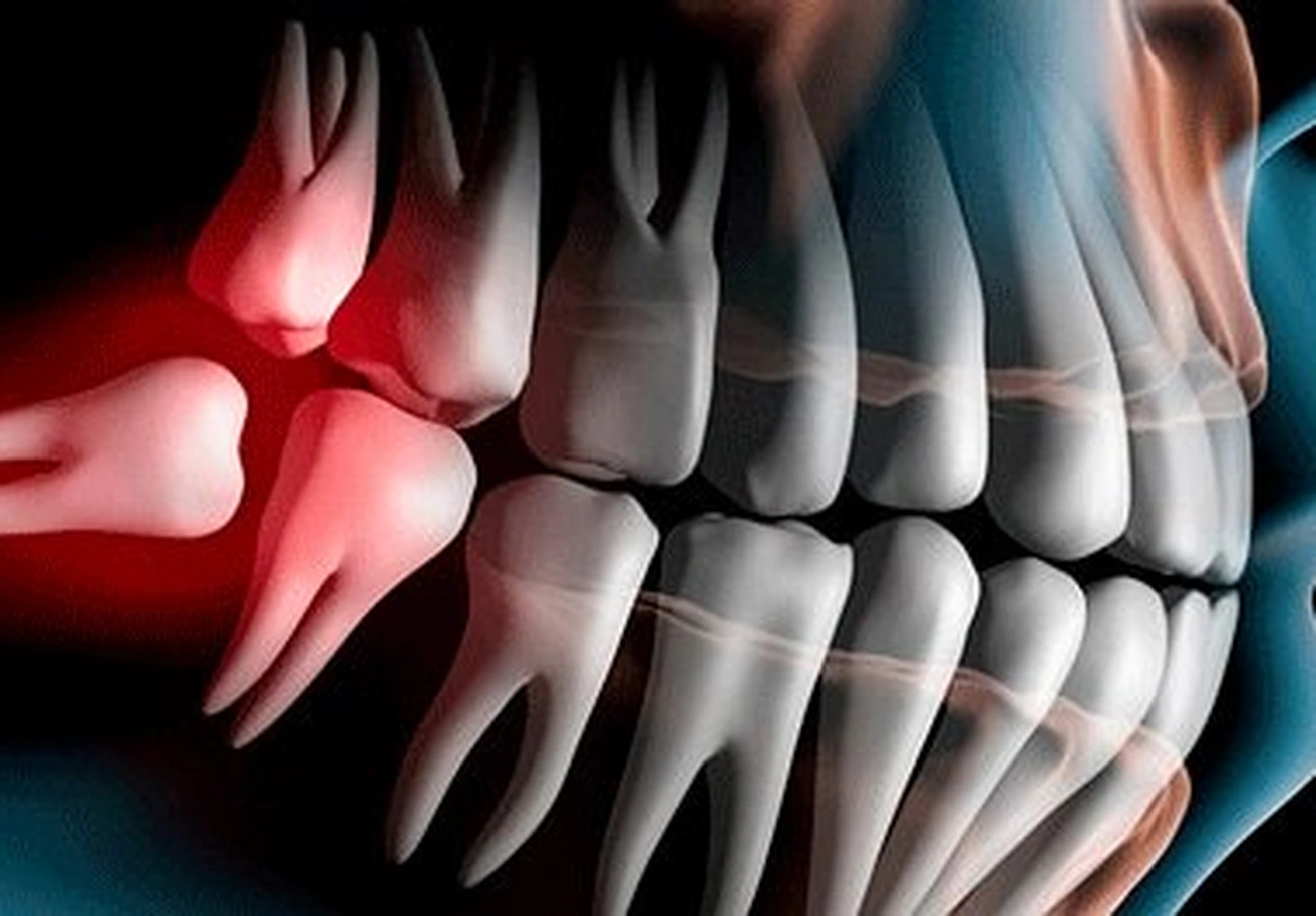 Как долго болит зуб мудрости когда растет, и чем снять боль?