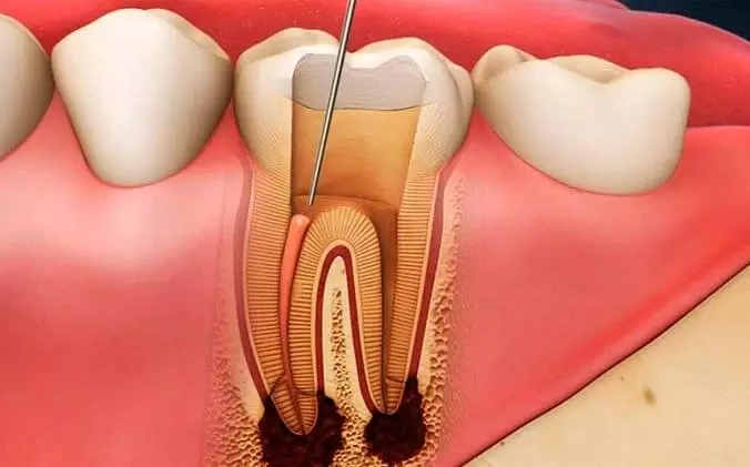 Болит зуб после удаления нерва — что делать?