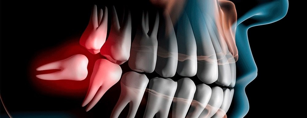 Как снять неприятные симптомы, возникшие из-за роста зуба мудрости