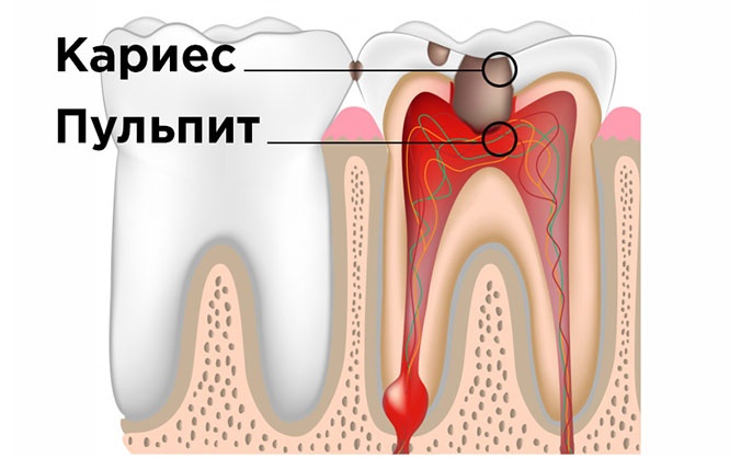 Сколько по времени лечить пульпит?